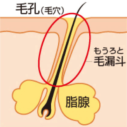 ニキビの発生1